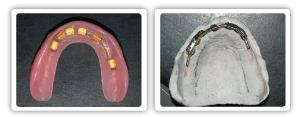 dental implant restoration 